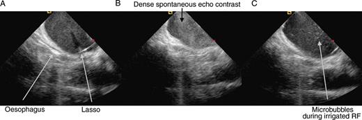 Left atrial imaging using intracardiac echocardiography during Lasso-guided pulmonary vein antrum isolation. (A) Mild spontaneous echo contrast at the beginning of ablation, (B) dense echocontrast—‘sludge’—in the left atrium during a ventricular pause, and (C) microbubbles typically seen during ongoing irrigated ablation of the left atrium while supporting ventricular rhythm with right ventricular apical stimulation.