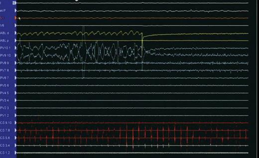 Pause during ablation. Listed from top down are leads I, aVF, V1, and V6 followed by ablation distal and proximal electrograms and Lasso electrograms from proximal to distal (pulmonary vein). Note ablation artefact on Lasso poles 7–8 and 8–9. These are followed by coronary sinus electrograms from proximal to distal.