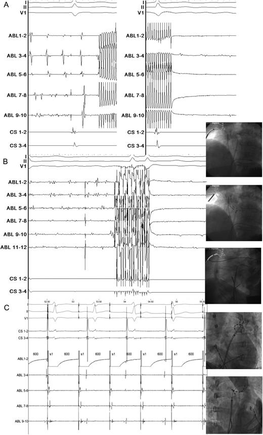 (opposite) (A) Pulmonary vein ablation catheter isolation during atrial fibrillation. Lead I, II, and V1 show electrocardiogram during atrial fibrillation, the quadripolar coronary sinus catheter is temporarily in the right ventricle for pacing purposes in case of vagal response during ablation. The five ablation (ABL) pairs show the local pulmonary vein antrum activity mapped with pulmonary vein ablation catheter. An artefact is observed when phased radiofrequency is started on all ablation pairs. After 60 s ablation at a target temperature of 60°C, the local voltage is greatly diminished. Paper speed with Prucka is 200 mm/s. (B) Complex-fractionated atrial electrograms ablation: septum, roof/floor/isthmus. Same catheter set-up as in Figure 1A. The six ABL pairs show septal activity recorded with the three armed multi-array septal catheter. During ablation the artefact persists for 60 s. After ablation local voltage abatement is observed. The fluoroscopy images show typical ablation positions with the multi-array septal catheter and multi-array ablation catheters. Paper speed with Prucka is 200 mm/s. (C) Local pulmonary vein capture, exit block. Same catheter set-up as in Figure 1A and B. The pulmonary vein ablation catheter catheter tip is positioned inside the left superior pulmonary vein. Pacing from ABL pair 1–2 shows local capture inside the pulmonary vein, while sinus rhythm continues undisturbed outside the pulmonary vein. Paper speed with Prucka is 200 mm/s.