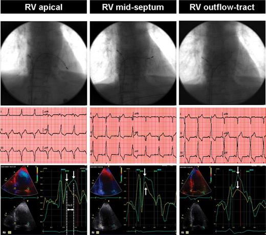 A comparison of RV apical, mid-septum, and outflow tract pacing lead sites using fluoroscopy, ECG, and dyssynchrony echocardiography: typical example. Top panel: fluoroscopic projections of the pacing leads. Middle panel: corresponding ECG traces. Apical pacing is associated with a leftward axis. In contrast, basal alternate site pacing positions were associated with more rightward axes. Bottom panel: corresponding colour tissue Doppler images (white arrows indicate peak systolic velocity in ejection phase). Systolic dyssynchrony at right ventricular apical pacing is demonstrated by the basal septal to lateral delay (SLD) of the peak systolic velocities, whereas with mid-septum and outflow tract pacing septal to lateral delay remains within normal limits. AVO and AVC: aortic valve opening and closure, respectively; MVO and MVC: mitral valve opening and closure, respectively.