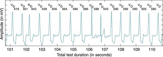 Typical 10 s segment of electrocardiogram and markers during the application of dynamic ventricular overdrive. The paced rate decreases gradually until the second R-wave triggers a new rate increase. V, ventricular pace marker; R, ventricular sense marker; D, event detected in post-processing; each number represents the intervals in milliseconds between two events detected in post-processing.