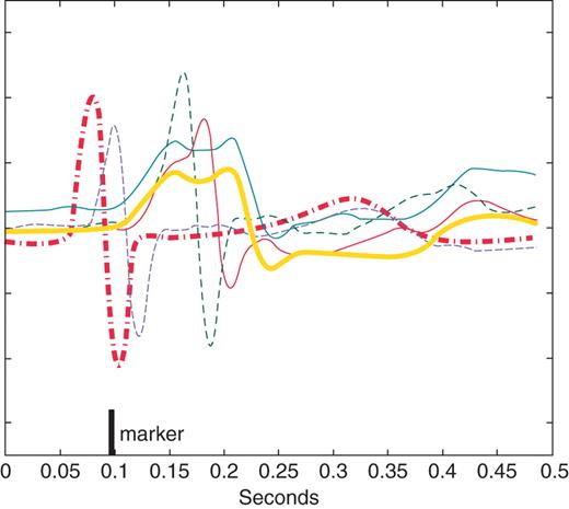 Example of calculation of the fusion index on four paced complexes (thin lines). To identify beats with intrinsic-like morphology, the average of all intrinsic complexes (thick red dashed line) and the average of all paced complexes (thick black solid line) were constructed for each pacing intervention. An amplitude-normalized cross-correlation with the intrinsic average and with the paced average was then calculated for each paced complex. Each complex having a larger peak correlation with the intrinsic average than with the paced average was deemed to have intrinsic-like morphology and scored as a fusion beat (thin dashed lines). The fusion index represents the proportion of fusion beats to the total number of paced beats.