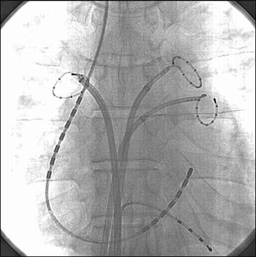 Catheter placement on fluoroscopy during internal electrical cardioversion. Anteroposterior view shows a quadripolar catheter at the right ventricular apex, a 7 + 7-polar catheter in the distal coronary sinus and along the lateral wall of the right atrium, and decapolar ring catheters in the left superior pulmonary vein, left inferior pulmonary vein, and right superior pulmonary vein.