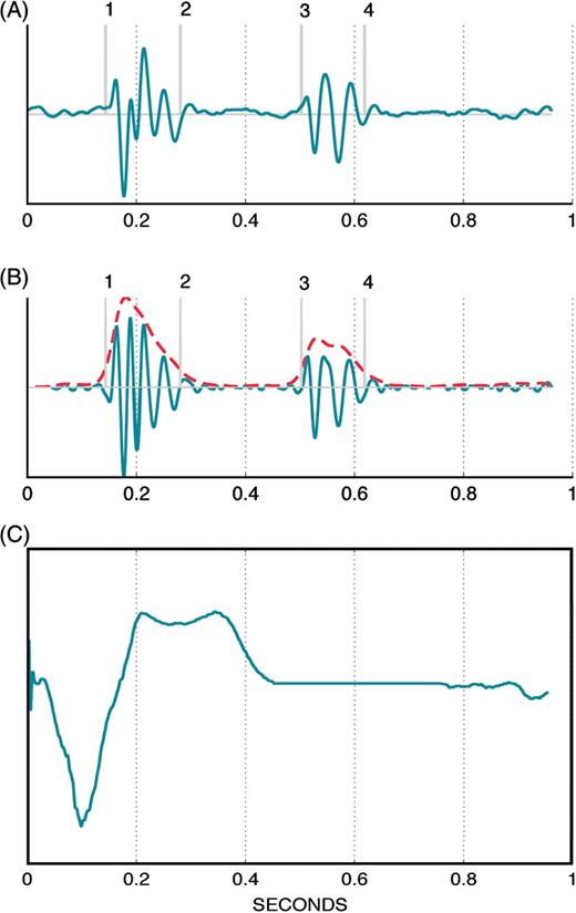 (A) Representative example of an average sonR cycle composed of 15 consecutive, ensemble-averaged cycles (B). The same average sonR cycle, high-pass filtered, and its envelope in doted gray line. The vertical markers are the detected components of sonR1 and sonR2, including, consecutively (1) tsonR1_onset, (2) tsonR1_end, (3) tsonR2_onset, and (4) tsonR2_end. t = 0, the onset of the cardiac cycle, is the pacing artefact or the QRS onset marker. (C) Average electrocardiographic signal composed of 15 consecutive, ensemble-averaged cycles.