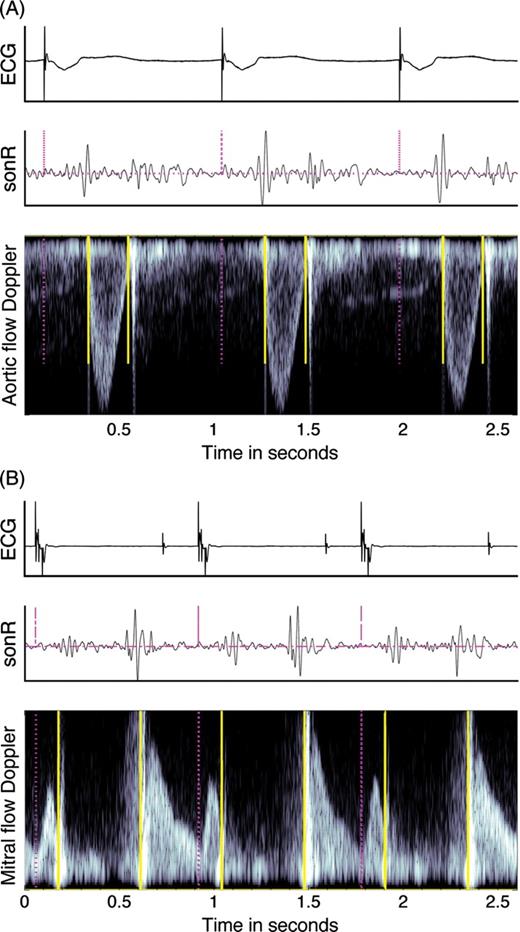 Example of markers on the aortic valve (A) and the mitral valve (B) pulsed wave Doppler. The pacing artefacts or QRS onset (dashed vertical lines) were automatically detected on the electrocardiogram (ECG); the sonR and the Doppler recordings were then segmented into individual cardiac cycles. The solid vertical lines mark the openings and closures of the aortic and mitral valves on the respective flow Doppler recordings.