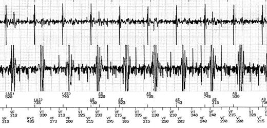 Rhythm strip stored by a Boston Scientific® Vitality 2DR® implantable cardioverter-defibrillator during cardiac magnetic resonance imaging. Endocardial electrogram and event markers (AS, atrial sensing; VT, ventricular tachycardia; VF, ventricular fibrillation). Even although stable sinus rhythm was confirmed by continuous ECG monitoring, a ventricular fibrillation episode was reported due to oversensing of radio frequency fields.
