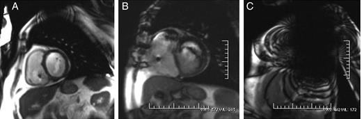 Cine true fast with steady-state precession (trueFISP) sequences during cardiac MRI from three different device patients. Case A shows little image artefact in the area adjacent to the generator (Group A). The imaging artefact in the case B was bigger but did not limit the MR diagnosis (Group B). Case C shows a severe imaging artefact which prevented reaching the diagnosis.