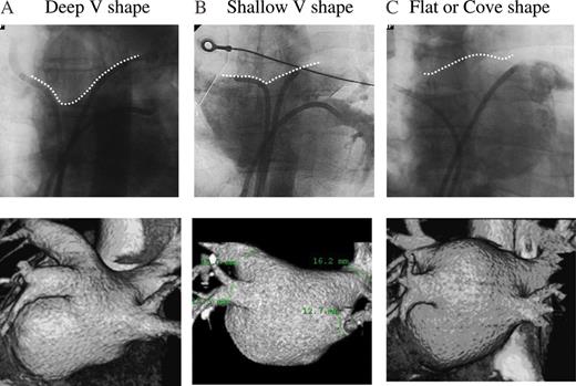 According to the pulmonary vein and left atrial-dominant level, we classified the left atrial roof shape into a deep V shape (A), shallow V shape (B), and flat-coved shape (C) by using cine angiography and 64-slice multi-detector-row computed tomography. The upper panels show the cineangiography, and the lower panels the 3D constructed image of the 64-slice multi-detector-row computed tomography. The deep V shape was mainly influenced by the segment of both trunks of the upper pulmonary veins, whereas the pulmonary veins were less incorporated into the left atrial with the flat-coved shape.