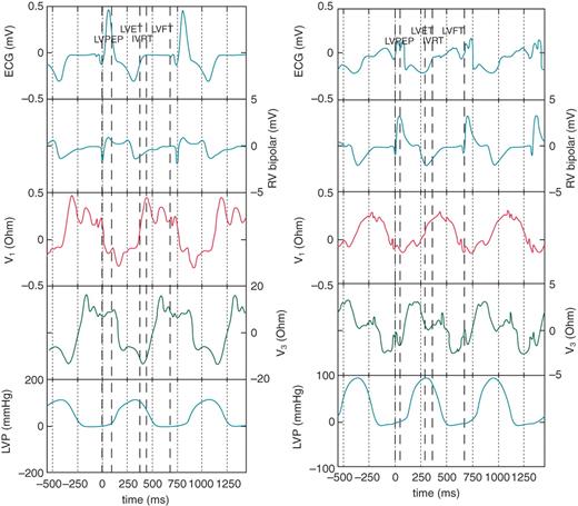 Simultaneous data sets are shown for Patients 2 (left) and 4 (right). These include (from top to bottom in the figure) the surface electrocardiogram, right ventricular bipolar electrogram, V1 impedance waveform, V3 impedance waveform, and left ventricular pressure trace.