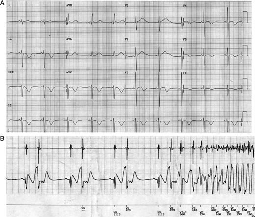 Twelve-lead electrocardiograph of a patient with long QT syndrome (A) and cardioverter defibrillator rhythm strip showing a run of ventricular bigeminy triggering ventricular fibrillation (B). The multiple ventricular fibrillation episodes required cardioverter defibrillator shocks to restore sinus rhythm, despite use of a regular β-blocker. Corrected QT interval on this electrocardiograph measured 580 ms.