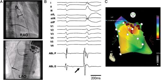 Catheter ablation of the PVCs triggering recurrent VF episodes in a patient with long QT syndrome (same patient as in Figure 1). (A) Fluoroscopic images (right and left anterior oblique views) of the ablation catheter at the site of origin of the premature ventricular complexes. (B) Twelve-lead surface electrocardiograph and ablation signal at earliest site (30 ms ahead of PVC onset). Note inferior axis of PVC and small Purkinje potential (PP- thick arrow) visible just before premature ventricular complex onset. (C) CARTO map of left ventricle (anterior view) showing multiple ablation points (brown circles) below the aortic valve area at the earliest site of triggering premature ventricular complexes. Coronary angiography (not shown) was performed to confirm that the ablation site was at a safe distance away from the epicardial coronary arteries. RAO, right anterior oblique view; LAO, left anterior oblique view.
