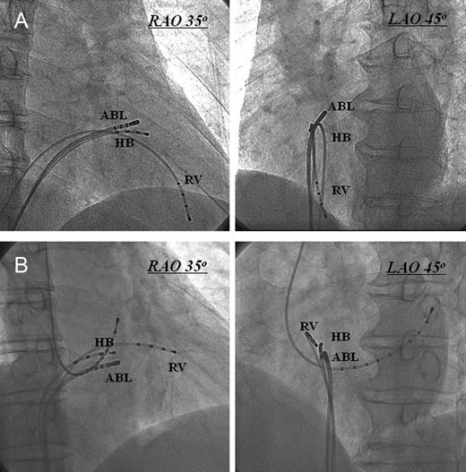 Right anterior oblique and LAO radiographic views of the ablation catheter at the typical sites of successful ablation. (A) Ablation catheter at the right ventricular antero-septum just above the His bundle region. (B) Ablation catheter at the right ventricular mid-septum just below the His bundle region. ABL, ablation catheter; HB, His bundle; LAO, left anterior oblique; RAO, right anterior oblique; RV, right ventricle.