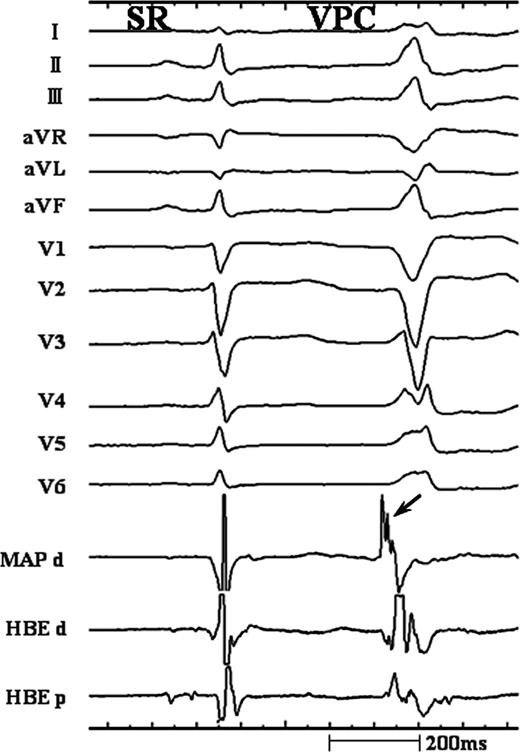 Intracardiac recordings at the successful ablation site of ventricular arrhythmia originating from the right ventricular mid-septum just inferior to the His bundle (HB). During the ventricular arrhythmia, the earliest ventricular activation recorded from the distal bipolar signal of mapping catheter (MAP d) and HB region preceded the onset of the QRS complex by 28 and 20 ms, respectively. Of note, high-frequency potential with fragmentation (arrow) was observed in the bipolar electrogram of MAP d.
