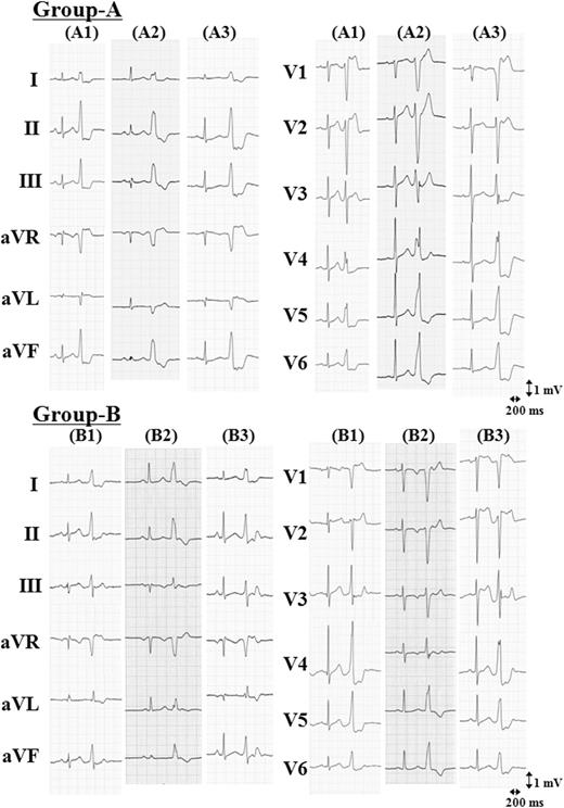 Representative 12-lead electrocardiograms of para-Hisian ventricular arrhythmiass. Ventricular arrhythmia originating from the right ventricular antero-septum above the His bundle region (Group-A). Ventricular arrhythmia originating from the right ventricular mid-septum below the His bundle region (Group-B).