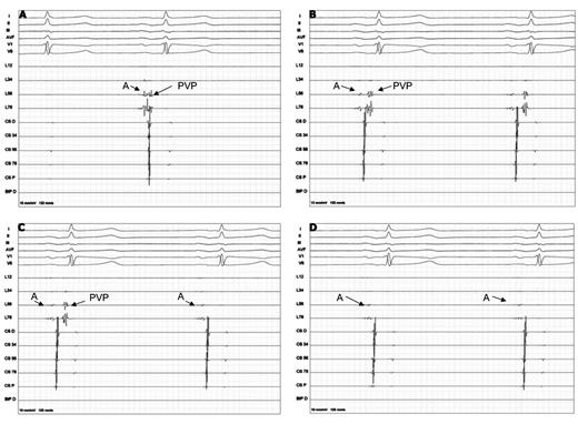 (A) Before ablation farfield left atrial signals (A) and the pulmonary vein potential are connected. (B) Progressive prolongation between the left atrial signal and the pulmonary vein potential during ablation. (C) Real-time 2:1 left atrial-pulmonary vein conduction during ablation (D) Electrical isolation during the freeze documented by real-time recordings.
