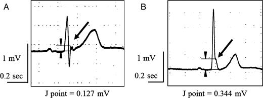 Electrocardiograms showing J-wave morphologies. (A) A notch-type J wave (arrow) is a positive deflection inscribed on the S wave. The amplitude of the J wave was measured as 0.127 mV. (B) A slur-type J wave (arrow) is a smooth transition from the QRS segment to the ST segment. The amplitude of the J wave was measured as 0.344 mV. The J wave was defined as positive when the J point was ≥0.1 mV above the isoelectric line ≥2 contiguous leads (arrowheads and lines).
