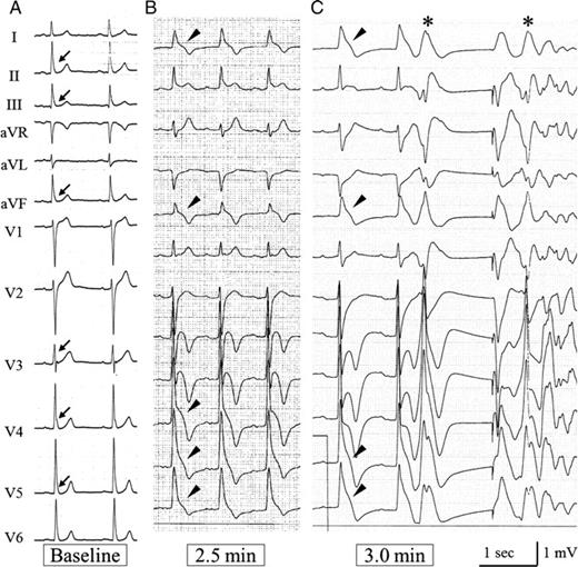 Electrocardiogram of Patient 4. (A) Baseline electrocardiogram shows slur-type J waves in the inferior and left precordial leads (arrows). (B) At 2.5 min after injection of acetylcholine into the left coronary artery, spasms were provoked in the left anterior descending and circumflex arteries and J waves developed in I, aVL, and V4–V6 leads (arrow heads). (C) These J waves were progressively augmented with a steep downward-sloping ST-segment elevation, and changed into a lambda-shaped pattern. After a long–short sequence, closely coupled premature beats (*) triggered ventricular fibrillation at 3.0 min.
