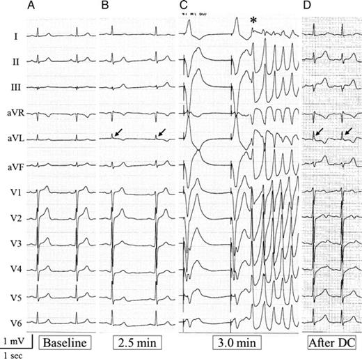 Electrocardiogram of Patient 19. (A) Baseline electrocardiogram shows no J wave. (B) At 2.5 min after injection of acetylcholine into the left coronary artery, spasms were provoked in the left anterior descending and circumflex arteries and an embryonic J wave (= 0.08 mV) developed only in the Lead aVL alone (arrow). (C) At 3.0 min, pacing beats were followed by a premature beat (*), which triggered ventricular fibrillation. (D) The small J wave (arrow) remained in the Lead aVL even after direct-current shock for restoration to sinus rhythm.