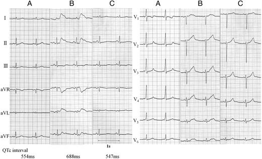 Twelve-lead electrocardiography before (A), immediately after catheter ablation for Wolff–Parkinson–White syndrome (B), and 2 days after the procedure (C). The increase in the QT interval observed immediately after the catheter ablation was restored to the baseline level 2 days after the procedure. The values of QTc interval in lead V2 were shown.