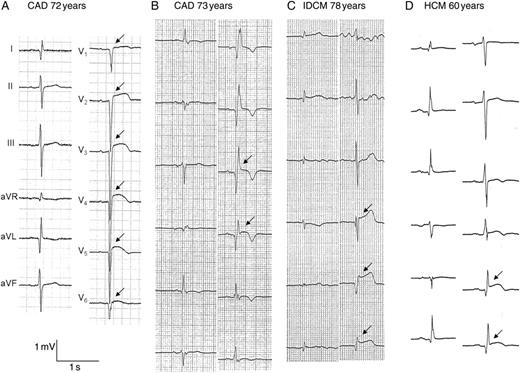Representative electrocardiographs of patients having electrical storm. (A, B) Electrocardiographs of patients with CAD. (A) Sustained ST-segment elevation and abnormal Q waves is seen in V1–V6 (arrow), and this patient had a broad anteroseptal old myocardial infarction and diffusely severe hypokinetic wall motion of the left ventricle. (B) Sustained ST-segment elevation and abnormal Q waves is seen in V3 and V4 (arrow), and this patient had an apical aneurysm. (C) Sustained ST-segment elevation and abnormal Q waves is seen in V4–V6 (arrow), and this patient had idiopathic dilated cardiomyopathy and diffusely hypokinetic wall motion of the left ventricle. (D) Sustained ST-segment elevation and abnormal Q waves is seen in V5 and V6, and this patient had hypertrophic cardiomyopathy with an apical aneurysm.