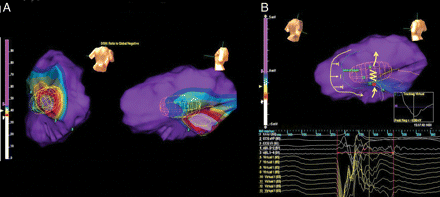 (A) Dynamic substrate mapping was analysed by a non-contact EnSite system. The wide yellow circumference encircles the area with peak negative voltage <34% of unipolar non-contact electrograms; a wide scar area was thus identified in the basal portion of the inferior was of the left ventricle. (B) Sinus rhythm propagation in the left ventricle. The yellow arrows describe the impulse propagation pattern identified by non-contact mapping. The impulse, travelling around a region of functional block in the mid portion of the inferolateral wall, activated the area between the scar tissue and the zone of functional block in postero-anterior direction. The yellow zig-zag line highlights an area of slow conduction in correspondence of virtual electrograms 11–13, evident as slowing of sinus rhythm impulse progression at video propagation analysis; those electrograms registered a slow continuous diastolic activity spanning to 200 ms after the surface QRS onset; the distal bipolar electrode of the ablation catheter placed in the area corresponding to the virtual electrode 13 recorded a late potential occurring a 200 ms after the surface QRS onset.