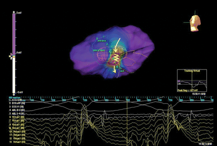Left ventricular activation during tachycardia analysed by non-contact mapping. The yellow arrows describe the direction of conducting channel activation during VT (antero-posterior direction). The yellow zig-zag line highlights an area of slow conduction in correspondence of virtual electrograms 10–11, evident as slowing of sinus rhythm impulse progression at video propagation analysis; virtual electrode 10, placed in the central portion of the conducting channel, registrated a small mid diastolic activity 70 ms before the surface QRS onset.