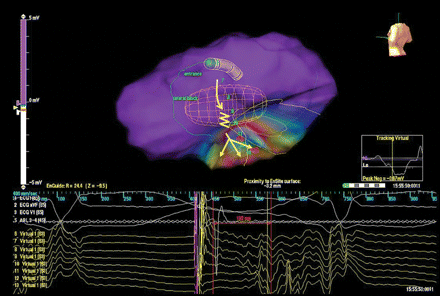 Characterization of impulse propagation during pacemapping. The stimulus-to-QRS interval is long (130 ms), consistent with slow conduction. Virtual electrograms in the area of supposed VT re-entry circuit registered a slow continuous activity between the pacing artefact and the surface QRS onset; when the impulse reached the site of virtual electrode 12, it spread out from the conducting channel to activate the left ventricle.