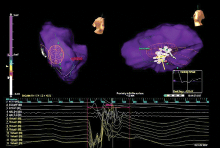 Left ventricular endocardial activation during sinus rhythm after radiofrequency ablation. The impulse reached the inferior wall following the same pathway used before radiofrequency ablation and it blocked at the virtual electrode 11; no late potential activity could be recorded after the QRS end (the red vertical caliper was placed at 200 m after the QRS onset).