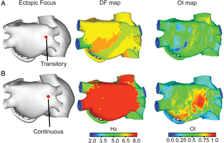 Dominant frequency maps (second column) and organization index maps (third column) during atrial fibrillation generated by an ectopic focus (A) transitory and (B) continuous, located in the ostium of the right pulmonary veins (first column).