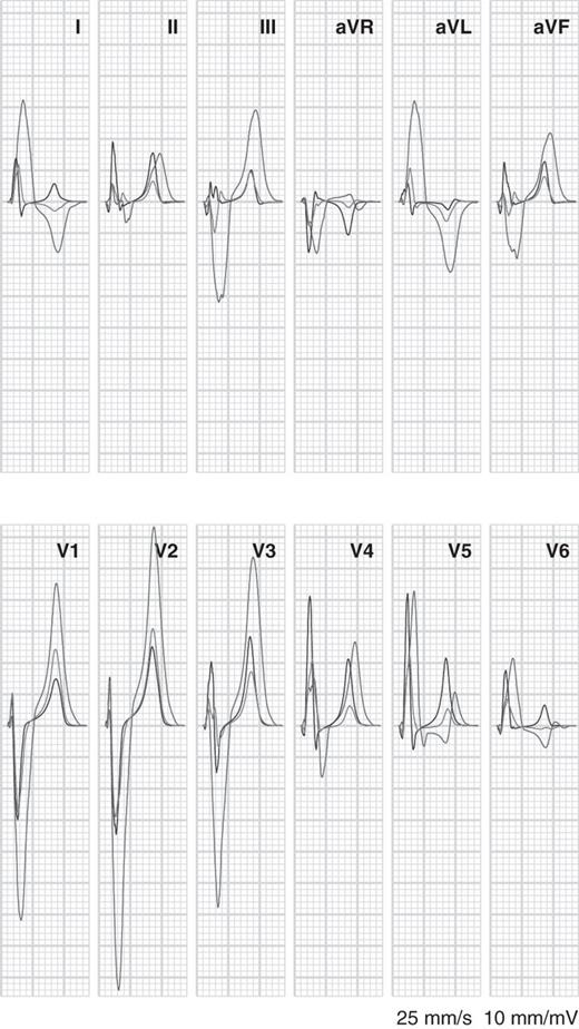 Simulated electrocardiograms for normal activation with normal conductivity (green), normal activation with 50% coupling in the left ventricular (blue), and left bundle-branch block with normal conductivity (red).