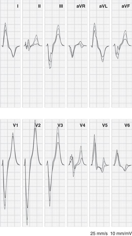 Simulated electrocardiograms for left bundle-branch block with normal tissue conductivity (red, same as red tracings in Figure 3), left bundle-branch block with 20% uncoupling in the left ventricular (blue), and left bundle-branch block with 50% uncoupling in the left ventricle (green).