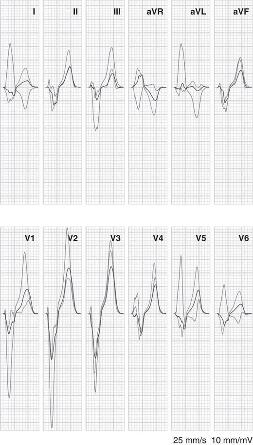 Simulated electrocardiograms for left bundle-branch block with normal tissue conductivity (red, same as red tracings in the previous figures), cardiac resynchronization therapy (blue), and cardiac resynchronization therapy with 50% uncoupling in the left ventricle (green).