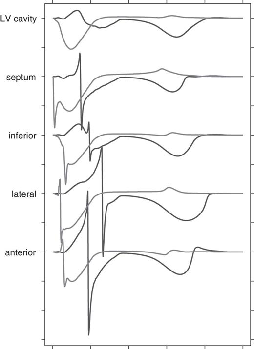 Simulated unipolar endocardial electrograms from the left ventricular at the level of the papillary muscles. Red Black: left bundle-branch block; blue: 50% uncoupling without left bundle-branch block. Tick marks along the vertical axis are 10 mV apart; those along the horizontal axis 100 ms. Wilson's central terminal was used as the reference.