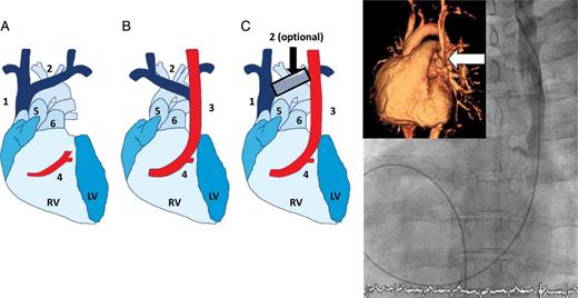 (Right side) (modified from Schreve-Steensma et al.4). Schematic overview of upper venous variations. (A) Normal situation. (B) Single left superior vena cava. (C) Double superior vena cava with or without a cross-connection. 1 = right superior vena cava, 2 = Innominate vein, 3 = left superior vena cava, 4 = coronary sinus, 5 = aorta, 5 = main pulmonary artery, RV = right ventricle, LV = left ventricle. (Left side) Venous angiogram of persistent left superior vena cava entering directly into the left atrium. Inserted image: three-dimensional magnetic resonance imaging (persistent left superior vena cava entry into the left atrium marked with arrow).