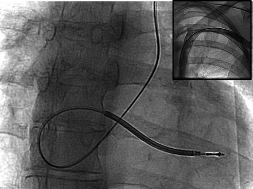 Alpha configuration in conventional chest X-ray (enlarged detail), and venous angiogram without cross branch to the right-sided upper veins (small inserted image).