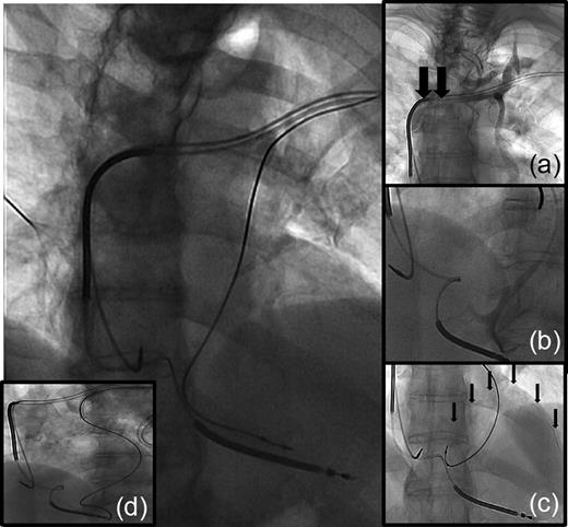 P/S lead via persistent left superior vena cava placed in a septal vein near the right ventricular apex. Inserted images: (a) venous situation demonstrates total occlusion (arrows) near the distal shock coil in the left brachiocephalic vein. (b) selective angiogram of distal veins (coronary sinus and side branches). (c) tip of guide wire in a posterolateral vein via origin coronary sinus, passage of coronary sinus into the target vessel was not possible with the over-the-wire lead. (d) over-the-wire implantation of the lead into a small septal vein, left anterior oblique projection confirm septal location of the lead tip.