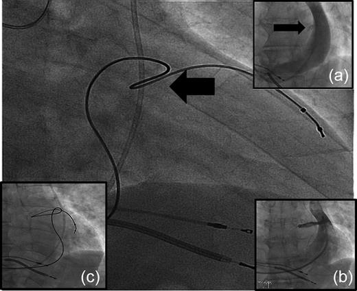 Cardiac resynchronization therapy–implantable cardioverter defibrillator via persistent left superior vena cava, right-sided approach due to an upgrade of a previously implanted dual-chamber pacemaker system. Inserted images: (a) venous angiogram of persistent left superior vena cava, flow-rate in this dilated persistent left superior vena cava was minimized using an occlusion balloon (balloon not shown), inserted via left cubital vein, to achieve an acceptable contrast. (b) selective angiogram of coronary sinus entrance into persistent left superior vena cava. (c) left anterior oblique projection confirms a posterolateral location of lead tip.