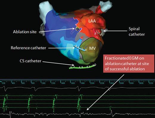 AP activation map showing area of constrained activation where early meets late. Entrainment from this site revealed it to be part of the reentrant tachycardia circuit. The electrogram on the ablation catheter at this site was heavily fractionated. Atrial tachycardia terminated with ablation at that site. After tachycardia termination, several applications are typically delivered around the site of successful termination and/or along a critical isthmus area to ensure durable interruption of the flutter circuits. LAA, left atrial appendage; MV, mitral valve.