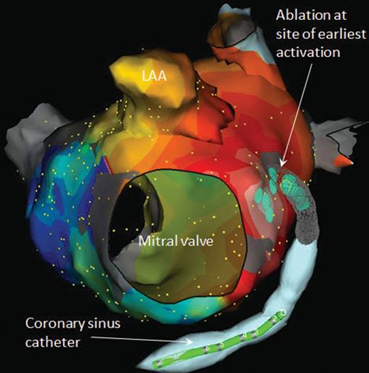 Left anterior oblique view of activation map of peri-mitral focal atrial tachycardia. The map reveals passive activation spreading in all directions from a focal site of earliest activation. Ablation both endocardially and from within the CS was required to terminate this atrial tachycardia. LAA, left atrial appendage.