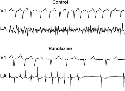 Representative example of surface (lead V1) and intracardiac electrograms (posterolateral left atrium, LA) at 12 min after atrial fibrillation (AF) initiation demonstrating early termination of AF by ranolazine. Note in the upper tracing (control) that AF is characterized by low voltage and high frequency. At the same time period, with ranolazine treatment, the arrhythmia became more organized, followed by conversion to sinus rhythm. (Reprinted from ref.24 with permission from John Wiley & Sons.).