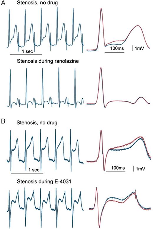 T-wave alternans (TWA) during left anterior descending coronary artery stenosis. The tracings with and without ranolazine (A) or E-4031 (B) are continuous (left panels) and with QRS-aligned superimposition (right panels). The stenosis-induced TWA was suppressed by ranolazine but not by E-4031. (Reprinted from ref.25 with permission from Heart Rhythm Society.)