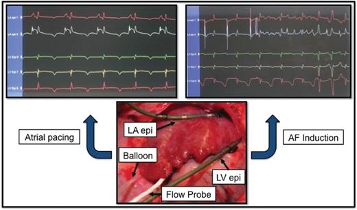 Experimental setup. Upper left panel: left atrial (LA) and left ventricular (LV) epicardial electrocardiograms obtained prior to balloon occlusion of the left circumflex (LCx) coronary artery to reduce flow by 75% during atrial pacing at 150 beats/min. Upper right panel: Induction of atrial fibrillation (AF) by a 6-mA S2 test stimulus following the last S1 pacing stimulus. Note visible T-wave heterogeneity compared to the uniform pattern observed in the upper left panel. Lower panel: Hydraulic balloon occluder positioned around the proximal LCx coronary artery upstream of the Doppler flow probe. Electrode catheters are affixed to the left atrial appendage and left ventricular epicardium within the atrial and ventricular regions supplied by the LCx. (Reprinted from ref. 47 with permission from Heart Rhythm Society.)