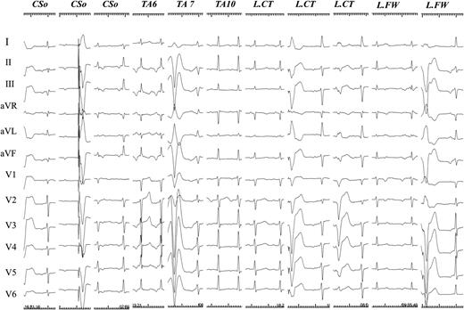 P-wave morphology during ectopic atrial tachycardias (25 mm/s). P-wave morphology was shown on a standard 12-lead ECG during ectopic atrial tachycardia originating from the lower right atrium. CSo, coronary sinus ostium; TA, tricuspid annulus; TA6, at 6 o'clock position of TA; TA7, at 7 o'clock position of TA; TA9, at 9 o'clock position of TA; L.CT, lower crista terminalis; L.FW, lower free wall.