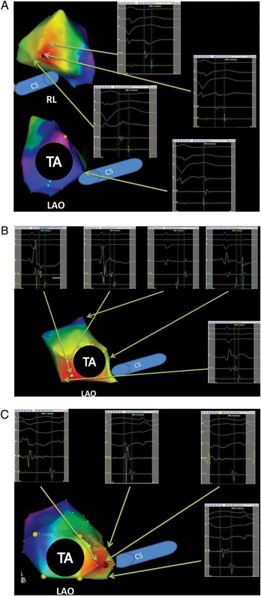 Three-dimensional electroanatomical mapping (activation map) and endocardial electrograms during ectopic atrial tachycardias. (A) The ectopic atrial tachycardia originated from the lower crista terminalis. The right inferior electrograms show mid-septum was activated later than coronary sinus ostium. The left superior activation map shows the earliest activation spot with fragmented potentials on the ablation catheter and sharply negative unipolar electrogram. (B) The activation map shows the ectopic atrial tachycardia originating from non-septal TA (7 o'clock). The right superior electrograms show mid-septum (posterior area of coronary sinus ostium) was activated later than coronary sinus ostium. (C) The activation map shows an ectopic atrial tachycardia originating from the coronary sinus ostium.