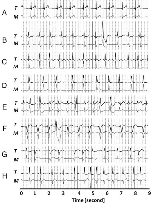 Examples of pairs of electrocardiogram tracings simultaneously obtained by Magic (M) and Trad ECG (T) in different patients. (A) Patient with normal sinusal rhythm. (B) Ventricular ectopic beat in a patient with ST depression. (C) Patient with atrial fibrillation (the f-wave is more evident in T than in M). (D) Other patient with atrial fibrillation (the f-wave is more evident in M than in T). (E) Patient with polymorphic ventricular ectopic beats. (F) Patient with pacemaker. (G) Patient with couplets of ventricular ectopic beats. (H) Patient during the onset of atrial fibrillation (in this patient during sinusal rhythm, the QRS morphology was different in the two recordings: type R for Trad-ECG and type RS for MagIC).