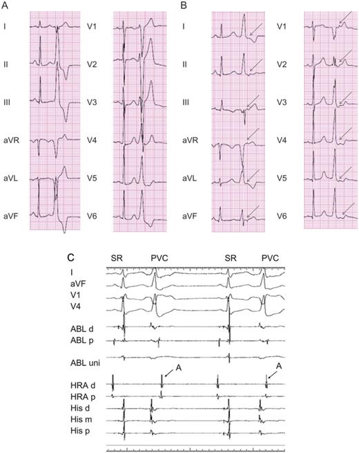 A representative 12-lead electrocardiogram showing a premature ventricular complex in the absence (A) and presence (B) of the retrograde P-wave. (A) Premature ventricular complexes with a left bundle branch block pattern and inferior-axis morphology were recorded. (B) The arrow denotes a retrograde P-wave following a premature ventricular complex. (C) An intracardiac electrogram during premature ventricular complexes showing retrograde atrial conduction. The distal electrode of the ablation catheter was positioned at the para-Hisian area. The arrows indicate retrograde atrial conduction.