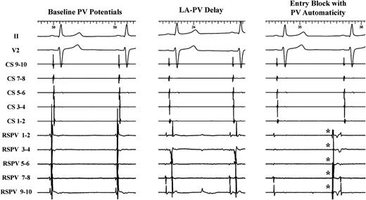 Pulmonary vein automaticity (*) as an unambiguous proof of LA–PV entry block (right tracing) in the RSPV. Note the complete elimination of PV potentials compared with the baseline recording (left tracing) and the progressive LA–PV delay before isolation (middle tracing). PV, pulmonary vein; CS, coronary sinus; RSPV, right superior PV; LA, left atrium.
