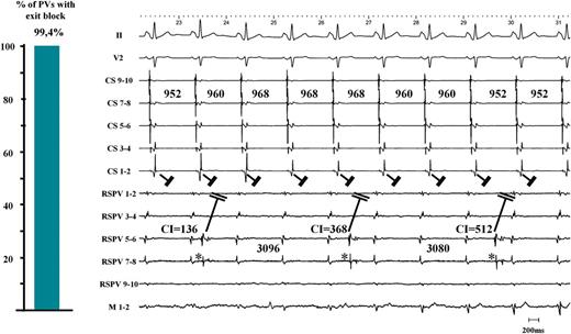 Left panel: in 170 out of 171 PVs we observed no residual PV–LA exit conduction after proven LA–PV entry block. Right panel: after encircling the right-sided PVs, a stable, regular, and slow PV rhythm (*) appeared in the RSPV (2651 ± 68 ms) during underlying sinus rhythm (976 ± 24 ms). Together with the elimination of PV potentials (only far-field potentials resided on the CMC with timing consistent with far-field RA activation), this unambiguously proved LA–PV entry block. Three PV automaticity beats with a coupling interval of 136, 368, and 512 ms are shown. None of these PV beats advanced LA activation or altered the CS activation pattern. CS, coronary sinus; RSPV, right superior pulmonary vein; M, mapping catheter; LA, left atrium; PV, pulmonary vein; CMC, circular mapping catheter.