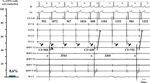 Left panel: only 1 single PV out of 171 PVs revealed residual PVLA exit conduction (0.6%) after proven LA–PV entry block. Right panel: the corresponding electrogram tracing is shown. PV automaticity beats (*) with a coupling interval of 968, 448, and 792 ms are shown. The two last beats advanced LA activation with a clear and consistent change in CS activation pattern. This proved residual PV–LA conduction and the presence of unidirectional block. CS, coronary sinus; RSPV, right superior pulmonary vein; M, mapping catheter; LA, left atrium; PV, pulmonary vein.