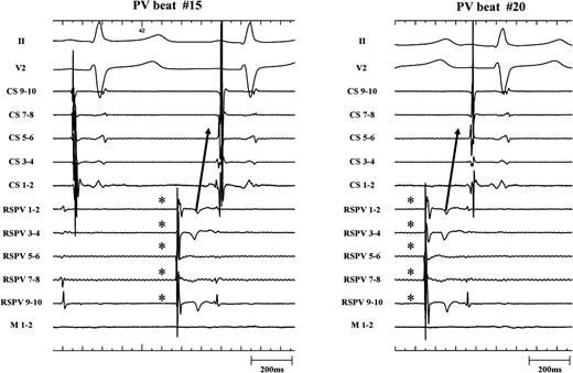 Representative electrograms at higher sweep speed illustrating the single case of unidirectional LA–PV block (same patient as Figure 4). Two PV automaticity beats (*) are shown. Clearly there is consistency in CS activation pattern and P-wave during capture. The CS activation pattern is different from the activation during sinus rhythm (left panel). CS, coronary sinus; LA, left atrium; PV, pulmonary vein.